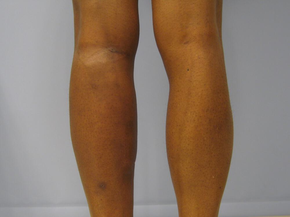 Calf Implants Before & After Image
