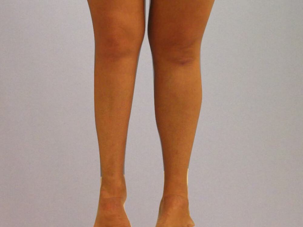 Calf Implants Before & After Image
