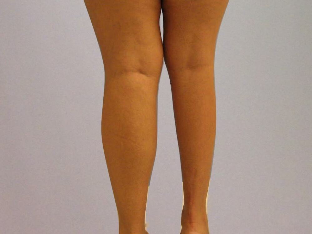 Calf Implants Before & After Image