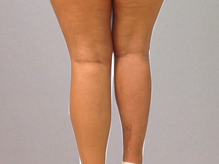 Calf Implants Before & After Image