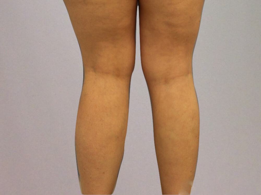 Calf implants body Before & After Image