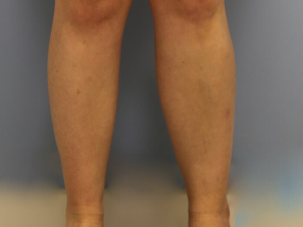 Calf implants body Before & After Image
