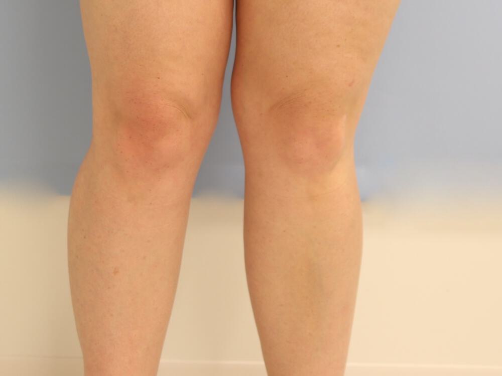 Calf implants body Before & After Image