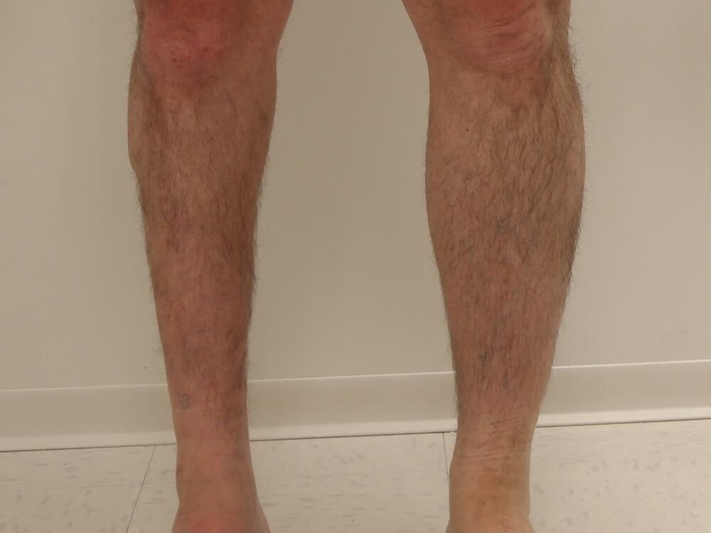 Calf implants body Before & After Image