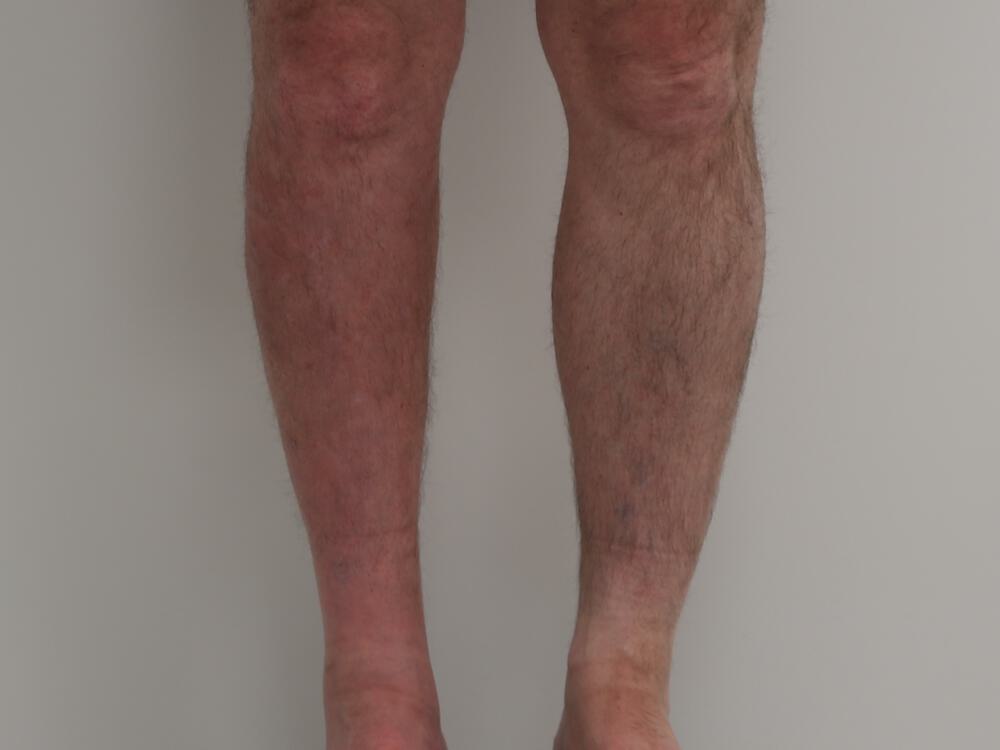 Calf implants body Before & After Image