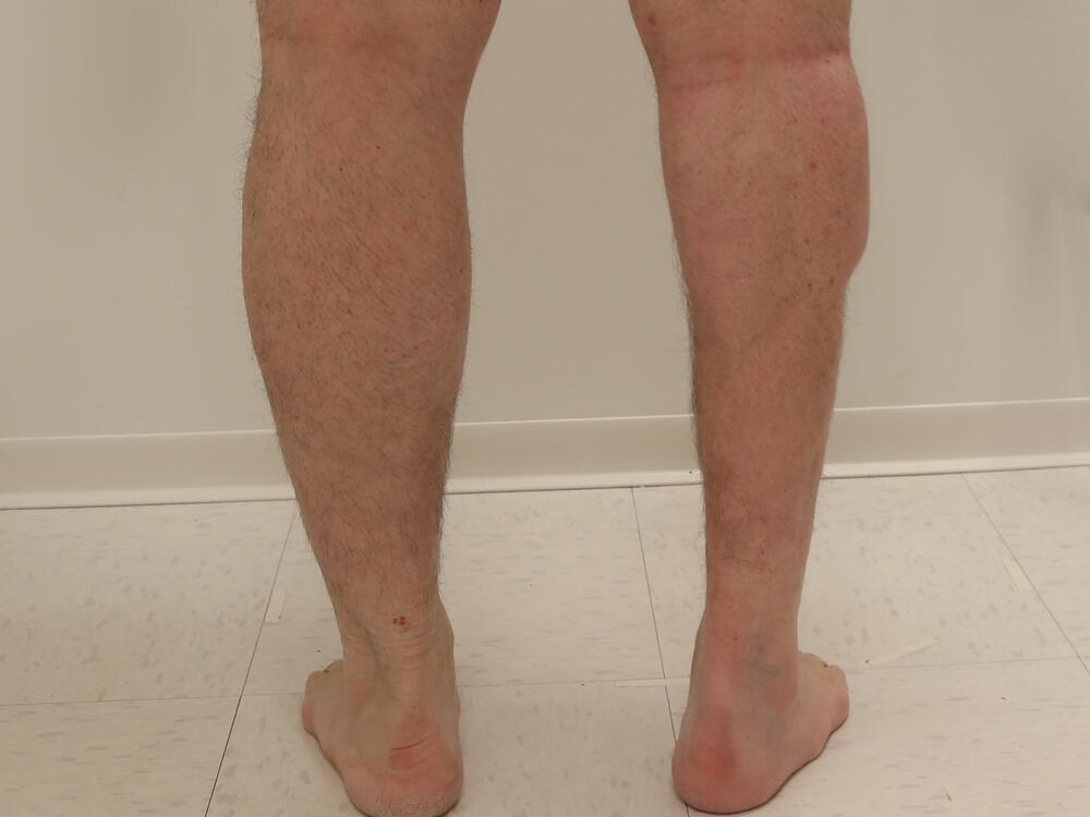 Calf implants body Before & After Image