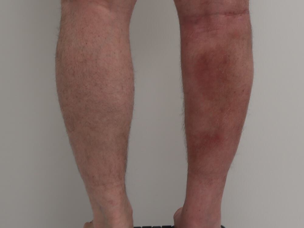 Calf implants body Before & After Image