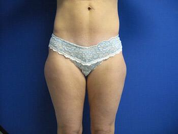 Liposuction Before & After Image