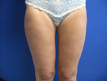 Liposuction Before & After Image