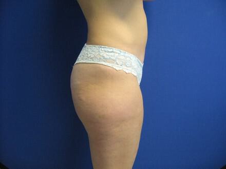 Liposuction Before & After Image