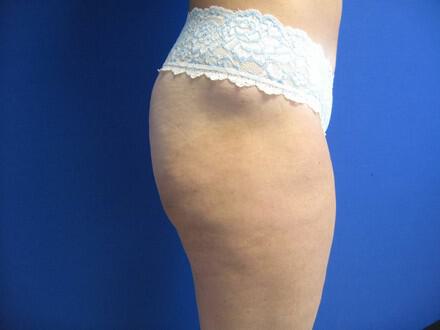 Liposuction Before & After Image