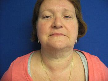 Liposuction Before & After Image