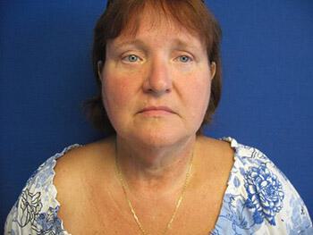 Liposuction Before & After Image