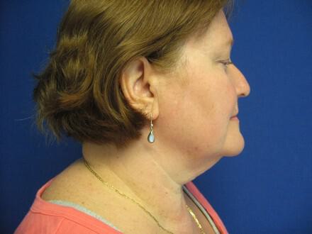 Liposuction Before & After Image