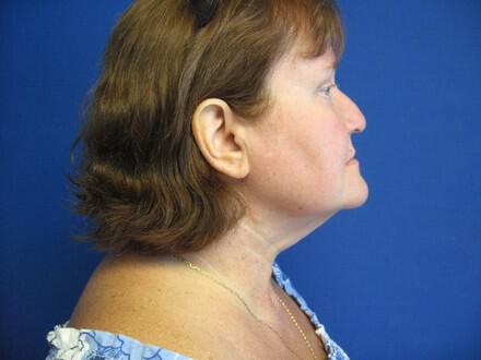 Liposuction Before & After Image