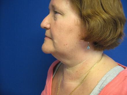 Liposuction Before & After Image