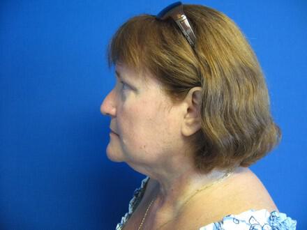 Liposuction Before & After Image