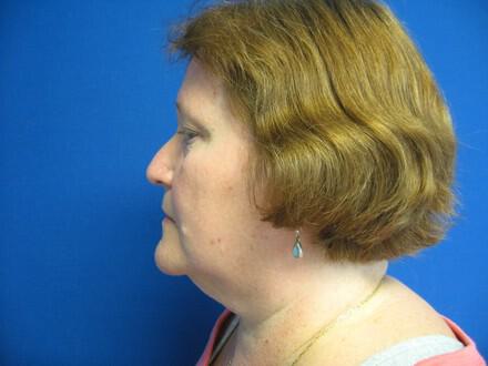 Liposuction Before & After Image