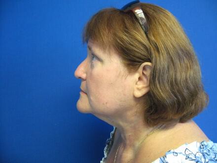 Liposuction Before & After Image