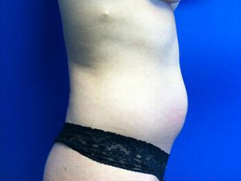 Liposuction Before & After Image