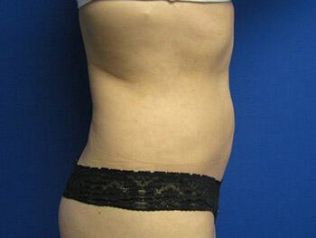 Liposuction Before & After Image