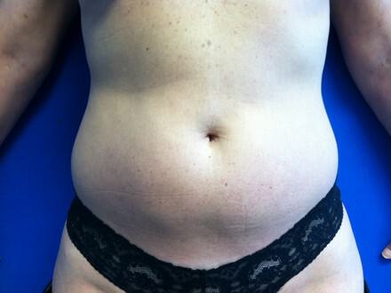 Liposuction Before & After Image