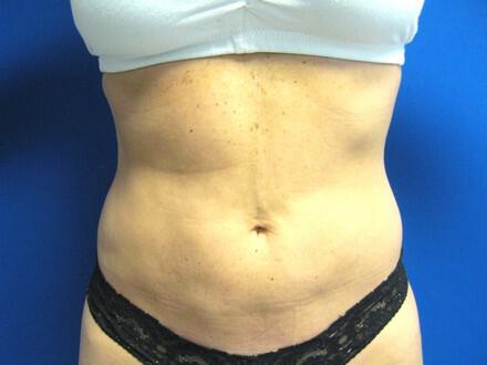 Liposuction Before & After Image