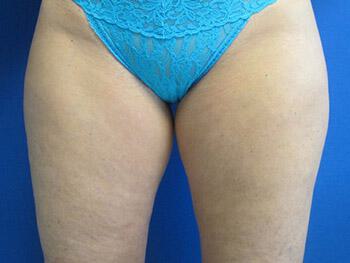 Liposuction Before & After Image