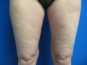 Liposuction Before & After Image