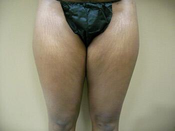 Liposuction Before & After Image