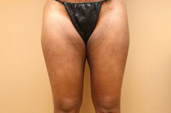 Liposuction Before & After Image