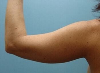 Liposuction Before & After Image