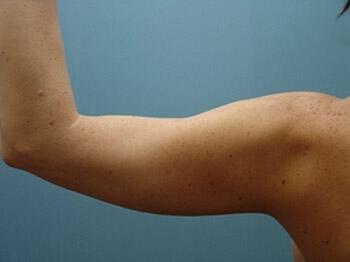 Liposuction Before & After Image