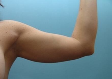 Liposuction Before & After Image