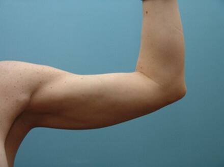 Liposuction Before & After Image