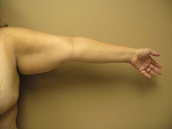 Liposuction Before & After Image