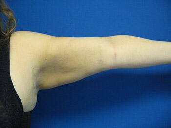 Liposuction Before & After Image