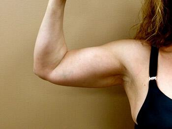 Liposuction Before & After Image