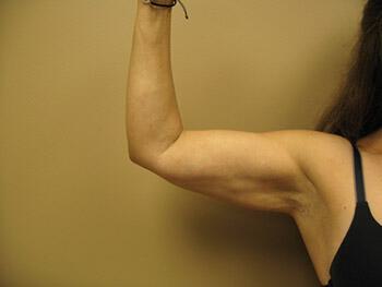 Liposuction Before & After Image