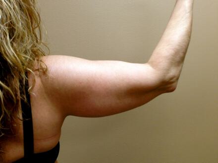 Liposuction Before & After Image