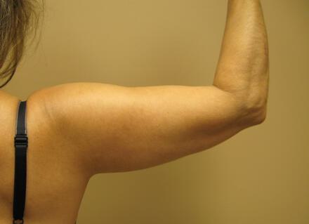 Liposuction Before & After Image