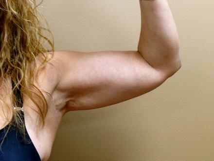 Liposuction Before & After Image