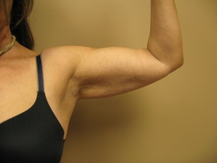 Liposuction Before & After Image