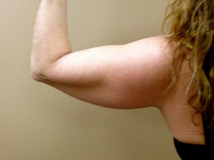 Liposuction Before & After Image