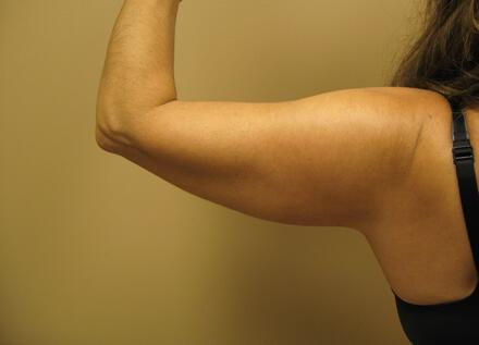 Liposuction Before & After Image