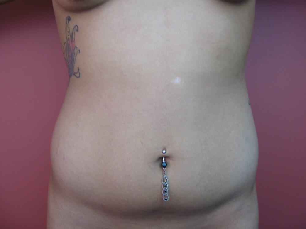Liposuction Before & After Image
