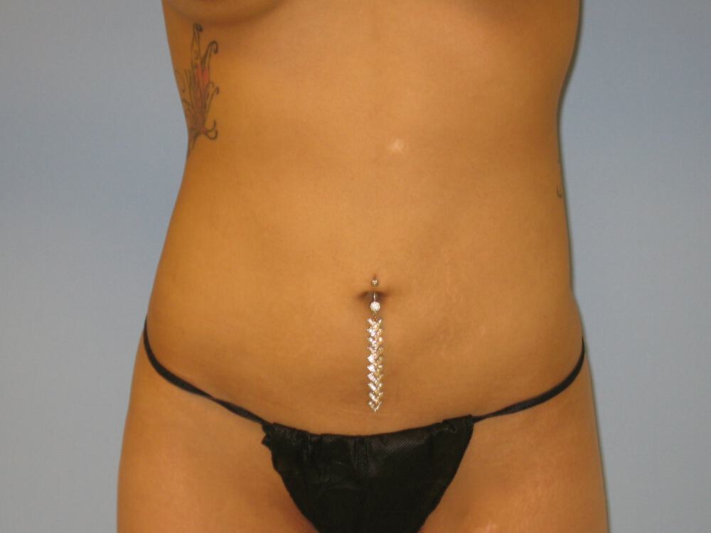 Liposuction Before & After Image