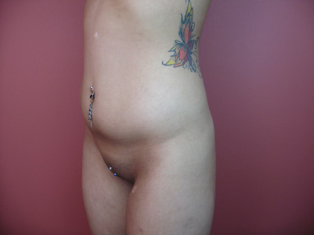 Liposuction Before & After Image