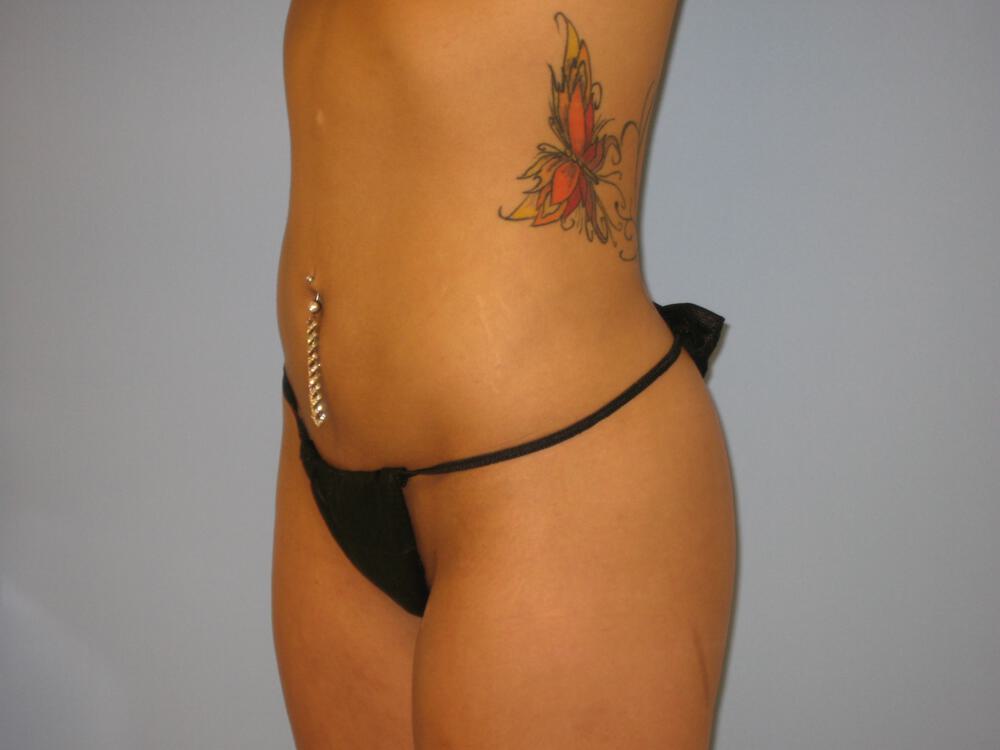 Liposuction Before & After Image