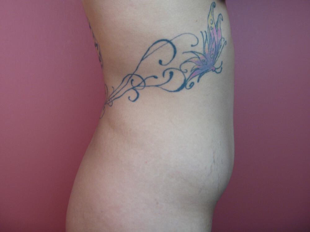 Liposuction Before & After Image